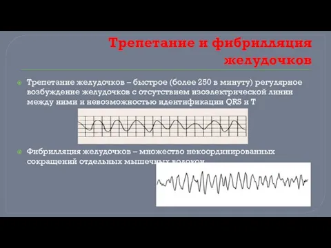 Трепетание и фибрилляция желудочков Трепетание желудочков – быстрое (более 250 в минуту)