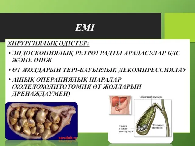 ЕМІ ХИРУРГИЯЛЫҚ ӘДІСТЕР: ЭНДОСКОПИЯЛЫҚ РЕТРОГРАДТЫ АРАЛАСУЛАР БДС ЖӘНЕ ӨШЖ ӨТ ЖОЛДАРЫН ТЕРІ-БАУЫРЛЫҚ