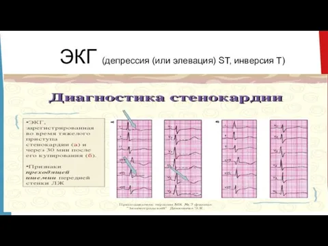 ЭКГ (депрессия (или элевация) ST, инверсия T)