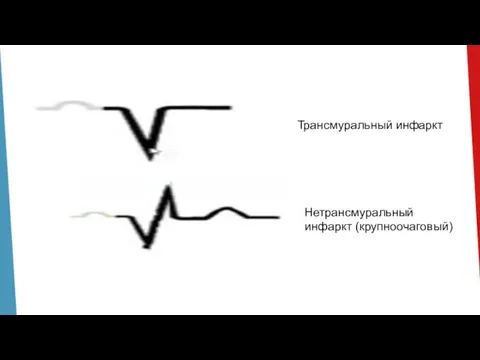 Трансмуральный инфаркт Нетрансмуральный инфаркт (крупноочаговый)