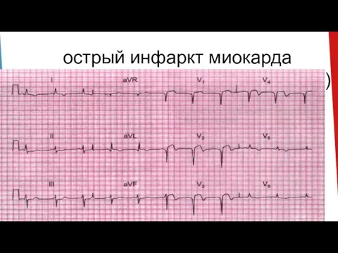 острый инфаркт миокарда передней стенки (трансмуральный)