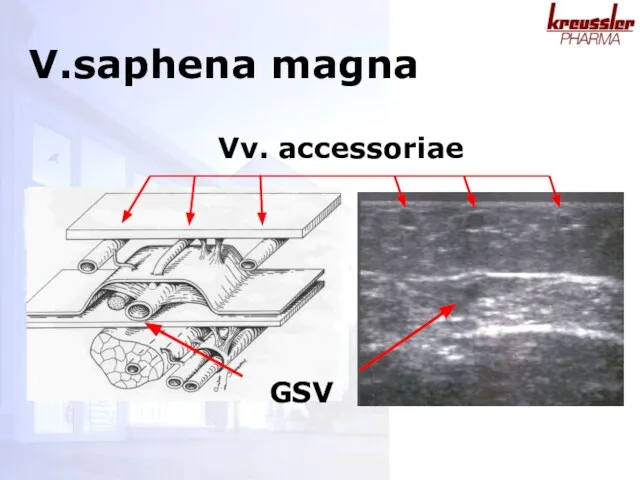 GSV Vv. accessoriae V.saphena magna
