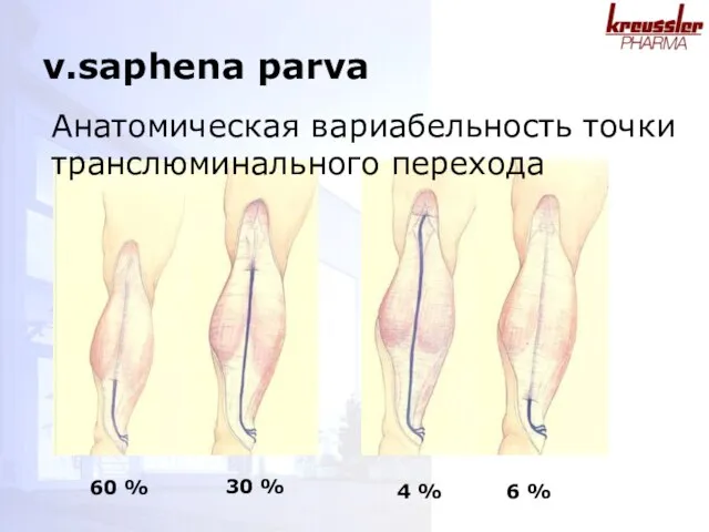 60 % 30 % 4 % 6 % v.saphena parva Анатомическая вариабельность точки транслюминального перехода