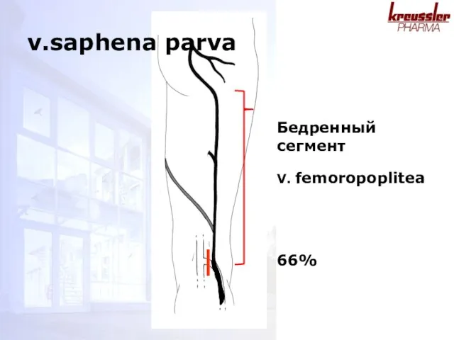 V. femoropoplitea 66% Бедренный сегмент v.saphena parva
