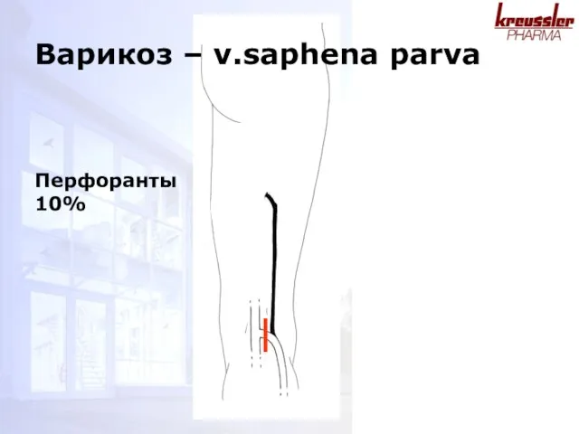 Перфоранты 10% Варикоз – v.saphena parva