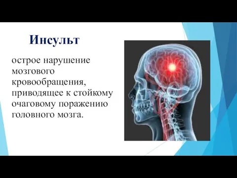 Инсульт острое нарушение мозгового кровообращения, приводящее к стойкому очаговому поражению головного мозга.