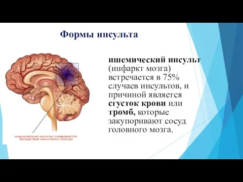 Формы инсульта ишемический инсульт (инфаркт мозга) встречается в 75% случаев инсультов, и