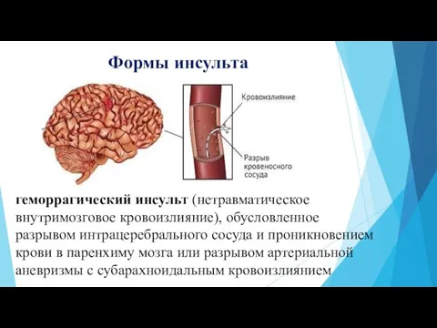 Формы инсульта геморрагический инсульт (нетравматическое внутримозговое кровоизлияние), обусловленное разрывом интрацеребрального сосуда и