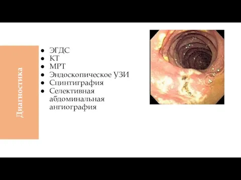 ЭГДС КТ МРТ Эндоскопическое УЗИ Сцинтиграфия Селективная абдоминальная ангиография Диагностика