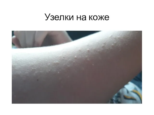 Узелки на коже