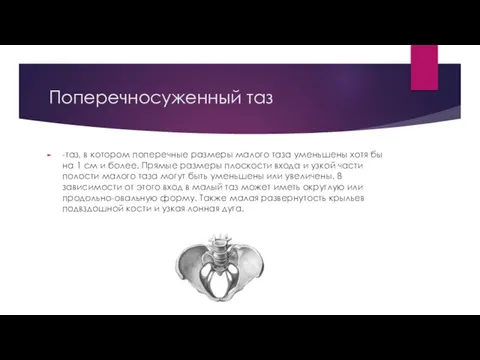 Поперечносуженный таз -таз, в котором поперечные размеры малого таза уменьшены хотя бы