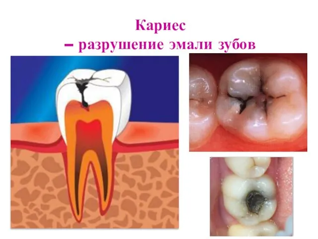 Кариес – разрушение эмали зубов