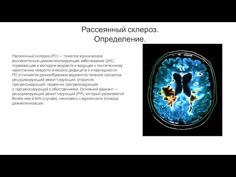 Рассеянный склероз. Определение. Рассеянный склероз (РС) — тяжелое хроническое воспалительно-демиелинизирующее заболевание ЦНС,