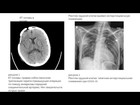 рисунок 1 КТ головы: правая лобно-височная трепанация черепа (предыдущая операция по поводу