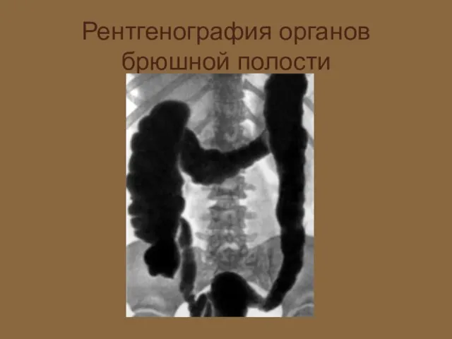 Рентгенография органов брюшной полости