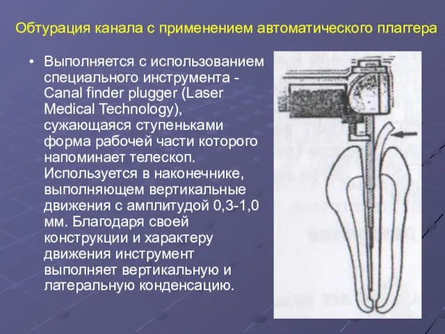 Обтурация канала с применением автоматического плаггера Выполняется с использованием специального инструмента -