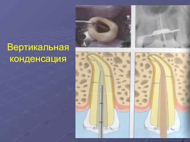 Вертикальная конденсация