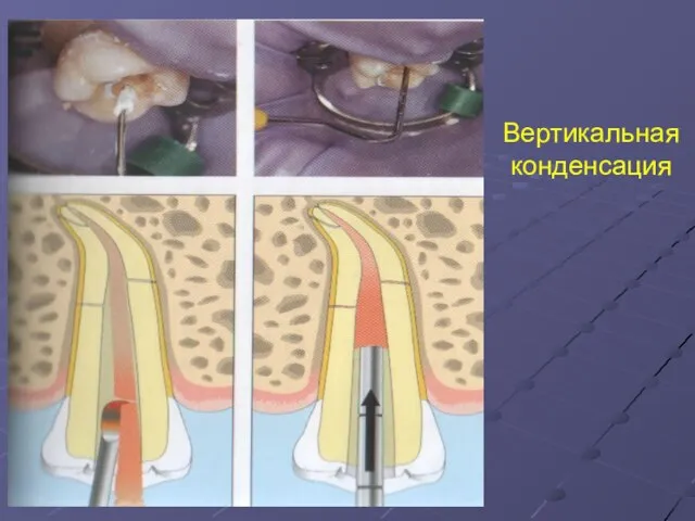 Вертикальная конденсация