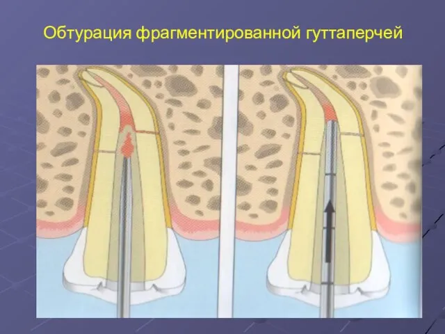 Обтурация фрагментированной гуттаперчей