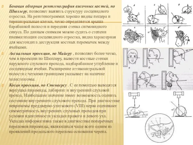 Боковая обзорная рентгенография височных костей, по Шюллеру, позволяет выявить структуру сосцевидного отростка.