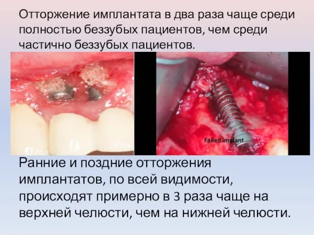 Отторжение имплантата в два раза чаще среди полностью беззубых пациентов, чем среди