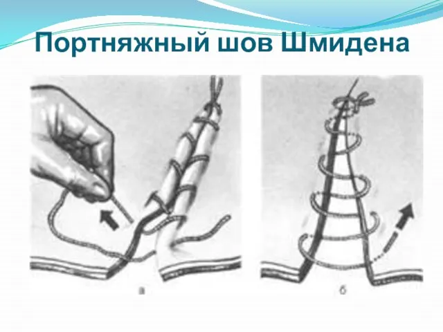 Портняжный шов Шмидена