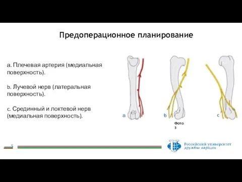 Предоперационное планирование а. Плечевая артерия (медиальная поверхность). b. Лучевой нерв (латеральная поверхность).