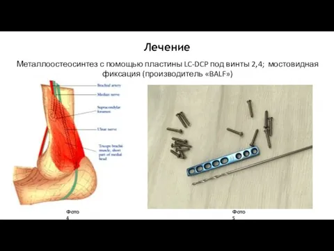 Лечение Металлоостеосинтез с помощью пластины LC-DCP под винты 2,4; мостовидная фиксация (производитель