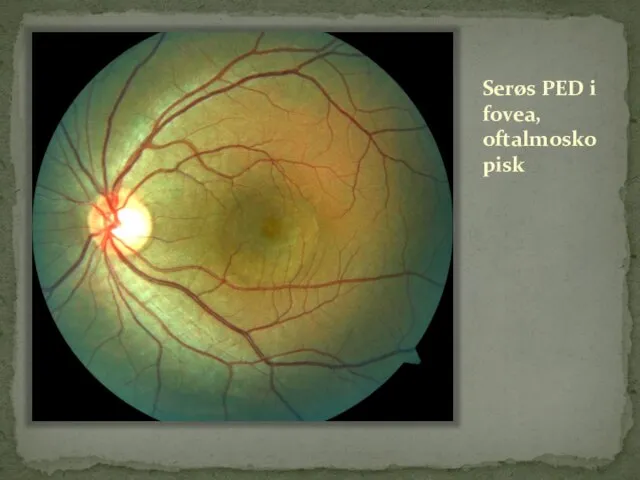 Serøs PED i fovea, oftalmoskopisk