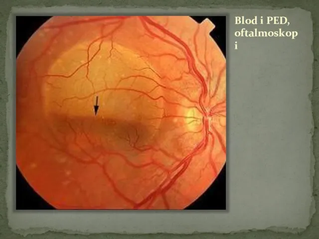 Blod i PED, oftalmoskopi