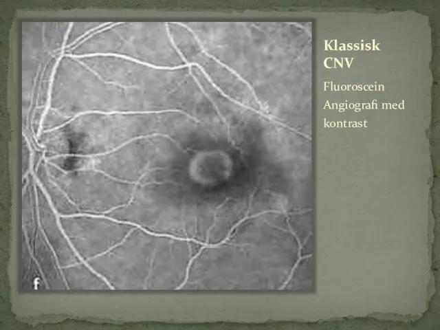 Klassisk CNV Fluoroscein Angiografi med kontrast