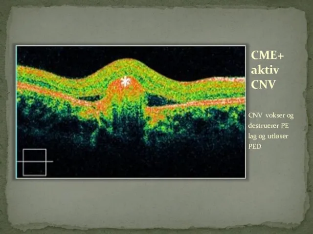 CME+ aktiv CNV CNV vokser og destruerer PE lag og utløser PED