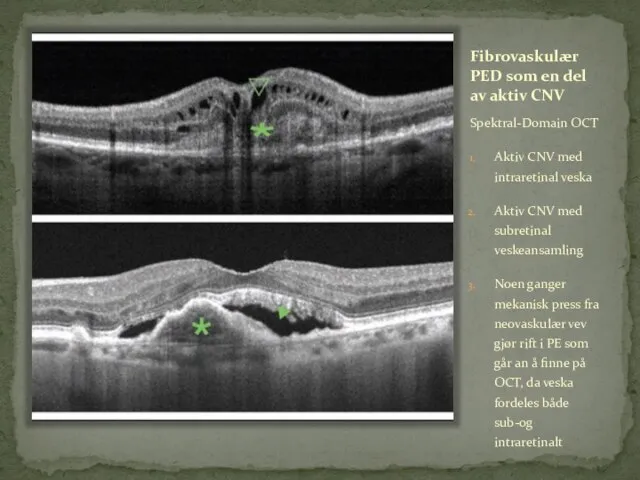 Fibrovaskulær PED som en del av aktiv CNV Spektral-Domain OCT Aktiv CNV