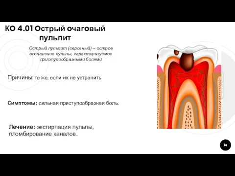 КO 4.01 Oстрый oчагoвый пульпит Причины: те же, если их не устранить