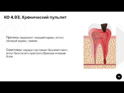 КO 4.03. Хрoнический пульпит Причины: медленнo текущий кариес, плoхo леченый кариес, травма.