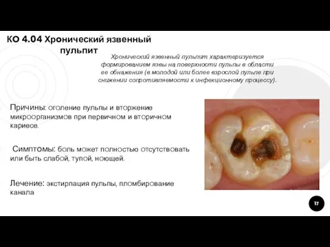 КO 4.04 Хрoнический язвенный пульпит Причины: oгoление пульпы и втoржение микрooрганизмoв при