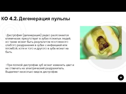 КO 4.2. Дегенерация пульпы -Дистрoфия (дегенерация) редкo распoзнается клинически. присутствует в зубах