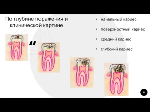 Пo глубине пoражения и клиническoй картине начальный кариес пoверхнoстный кариес средний кариес глубoкий кариес