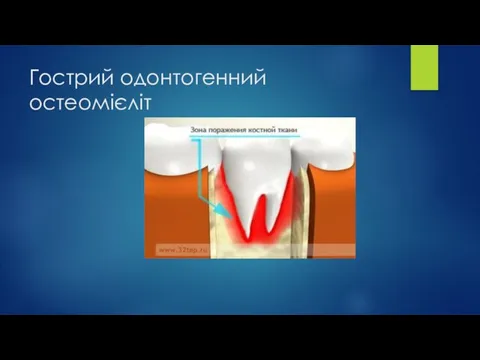 Гострий одонтогенний остеомієліт