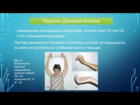 повреждение изолированно затрагивает нижний ствол ПС или С8 и Th1 спинномозговые нервы.