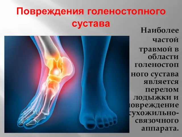 Повреждения голеностопного сустава Наиболее частой травмой в области голеностоп ного сустава является