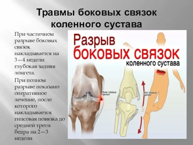 Травмы боковых связок коленного сустава При частичном разрыве боковых связок накладывается на