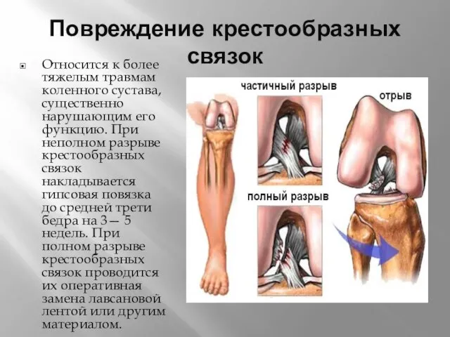 Повреждение крестообразных связок Относится к более тяжелым травмам коленного сустава, существенно нарушающим