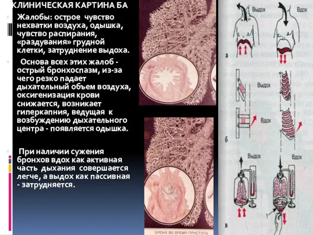 КЛИНИЧЕСКАЯ КАРТИНА БА Жалобы: острое чувство нехватки воздуха, одышка, чувство распирания, «раздувания»