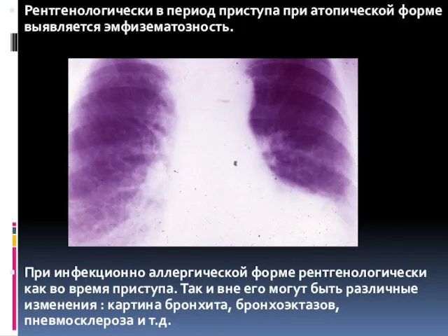 Рентгенологически в период приступа при атопической форме выявляется эмфизематозность. При инфекционно аллергической