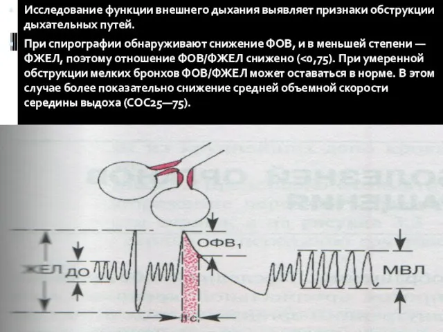 Исследование функции внешнего дыхания выявляет признаки обструкции дыхательных путей. При спирографии обнаруживают