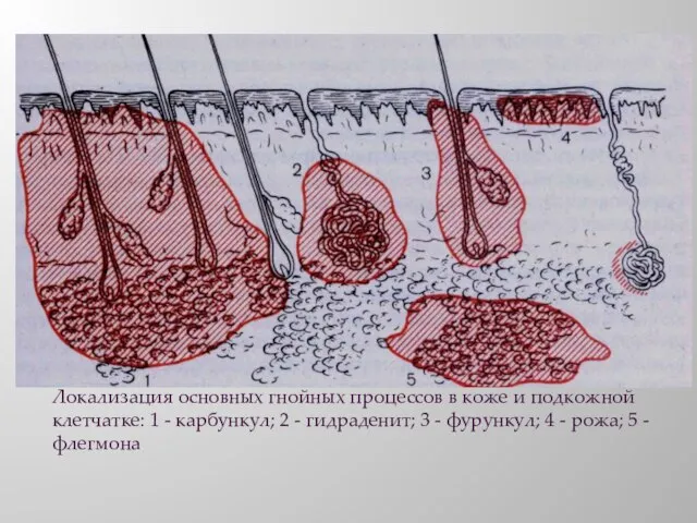 Локализация основных гнойных процессов в коже и подкожной клетчатке: 1 - карбункул;