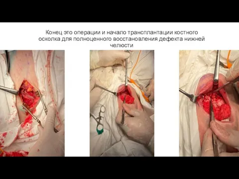 Конец это операции и начало трансплантации костного осколка для полноценного восстановления дефекта нижней челюсти