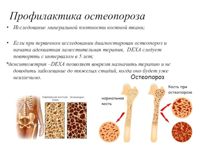 Профилактика остеопороза Исследование минеральной плотности костной ткани; Если при первичном исследовании диагностирован