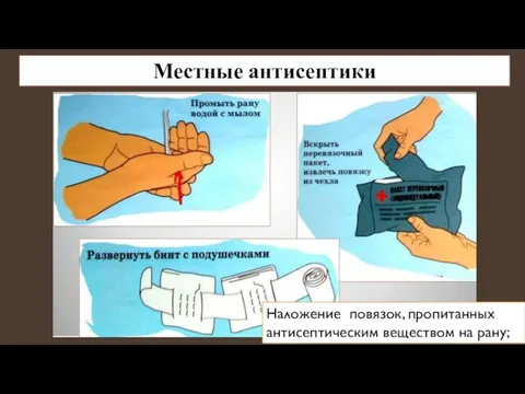 Местные антисептики Наложение повязок, пропитанных антисептическим веществом на рану;